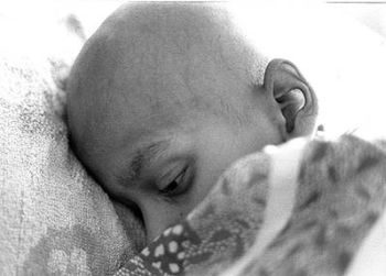 _an_iraqi_child_in_an_advanced_stage_of_leukemia.jpg